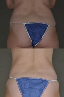 Tummy tuck and liposuction surgery