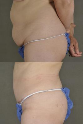 Tummy tuck