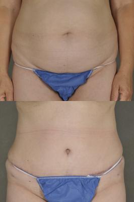 Tummy tuck