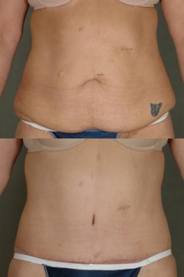 Tummy tuck