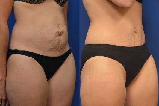 Tummy Tuck