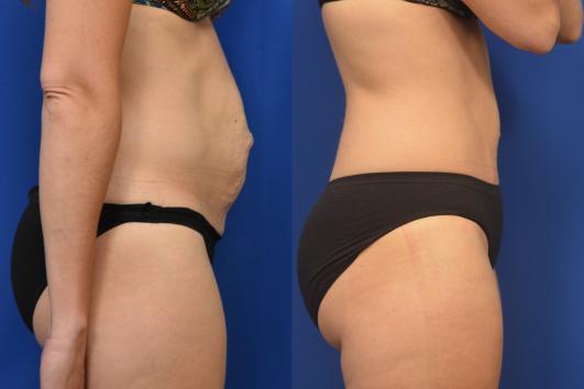 Tummy Tuck