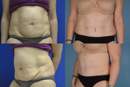 Tummy Tuck