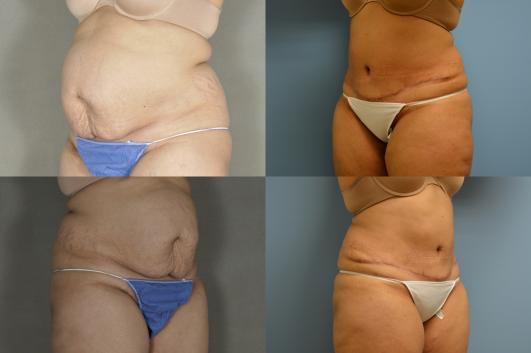 Tummy Tuck