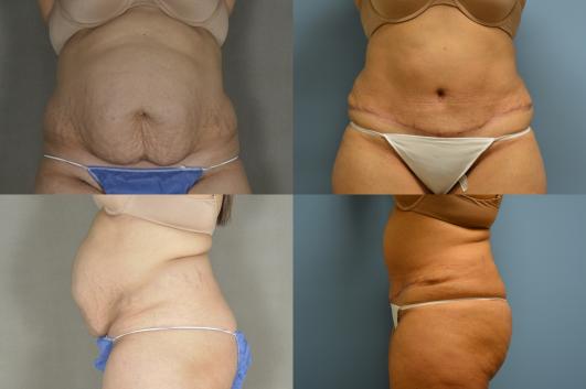 Tummy Tuck