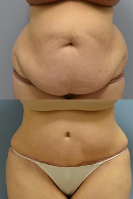 Abdominoplasty