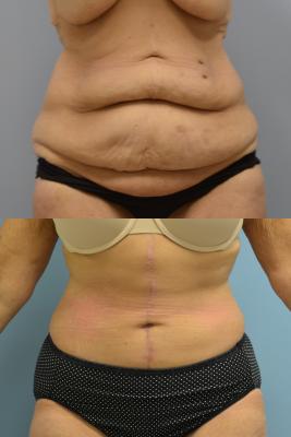 Abdominoplasty