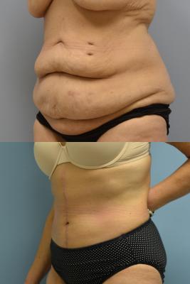 Abdominoplasty