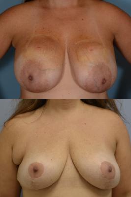 Breast Lift and Removal of Implants 