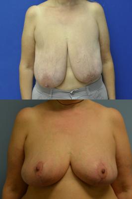 Breast Reduction