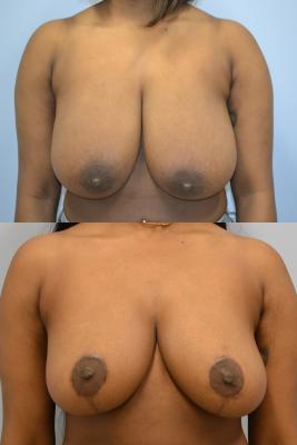 Breast Reduction 