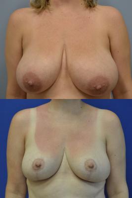 Breast Reduction