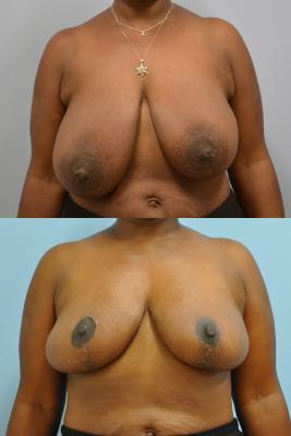 Breast Reduction