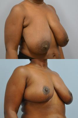 Breast Reduction 