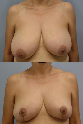 Breast Reduction