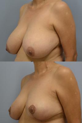 Breast Reduction 