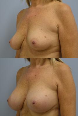 Before(top pic) After (bottom pic): Breast Reconstruction Oncoplastic Reduction and balancing augmentation