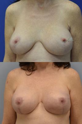 Before (top pic) After (bottom pic)-Breast Reconstruction