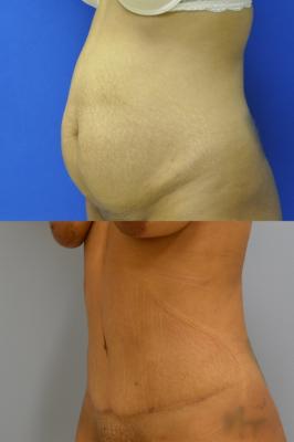 Abdominoplasty with Lipo 360 JJ1