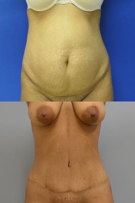 Abdominoplasty with Lipo 360 JJ1