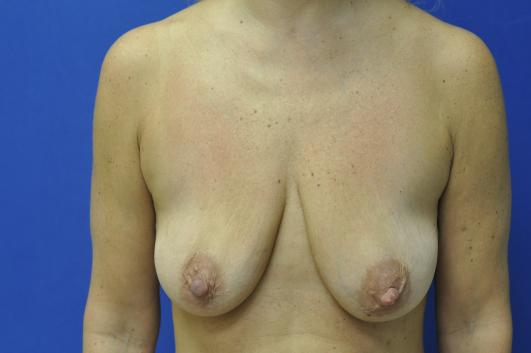 Before- Breast Reconstruction 