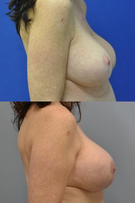 Before (top pic) After (bottom pic)-Breast Reconstruction