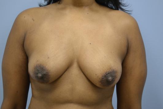 Before- Breast Reconstruction 