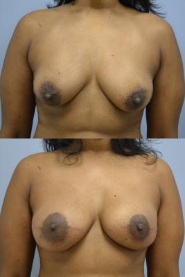 Before (top pic) After (bottom pic)-Breast Reconstruction