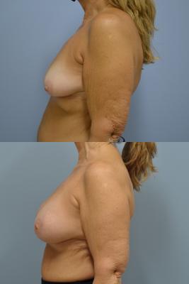 Before (top pic) After (bottom pic)-Breast Reconstruction