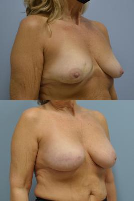 Before (top pic) After (bottom pic)-Breast Reconstruction