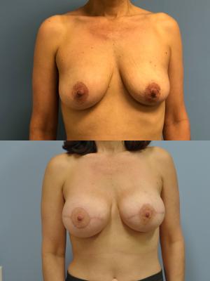 Before(top pic) After (bottom pic): Breast Reconstruction