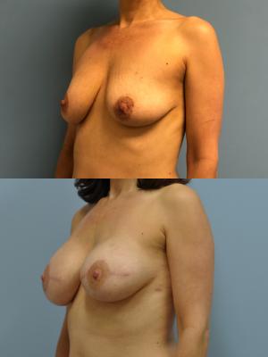 Before (top pic) After (bottom pic)-Breast Reconstruction