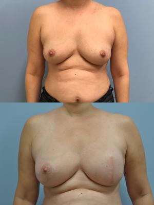 Before (top pic) After (bottom pic)-Breast Reconstruction