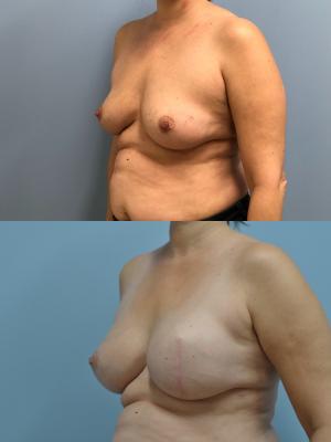 Before (top pic) After (bottom pic)-Breast Reconstruction