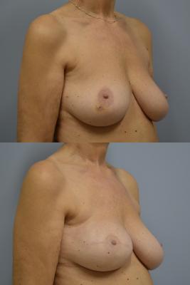 Before (top pic) After (bottom pic)-Breast Reconstruction