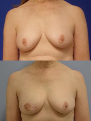 Before (top pic) After (bottom pic)-Breast Reconstruction