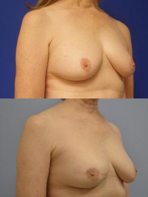 Before (top pic) After (bottom pic)-Breast Reconstruction