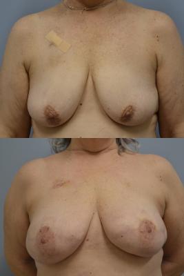 Before (top pic) After (bottom pic)-Breast Reconstruction