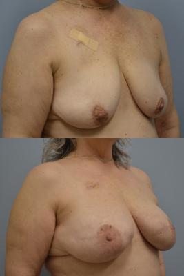 Before (top pic) After (bottom pic)-Breast Reconstruction