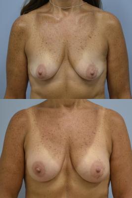 Before (top pic) After (bottom pic)-Breast Reconstruction