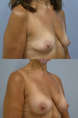 Before (top pic) After (bottom pic)-Breast Reconstruction