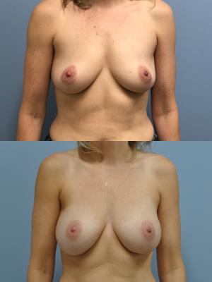 Before(top pic) After (bottom pic): Breast Reconstruction