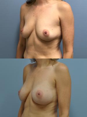 Before(top pic) After (bottom pic): Breast Reconstruction