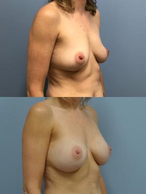 Before(top pic) After (bottom pic): Breast Reconstruction