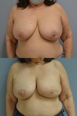 Before(top pic) After (bottom pic): Breast Reconstruction