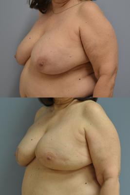 Before(top pic) After (bottom pic): Breast Reconstruction