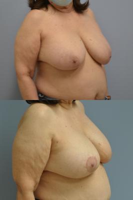 Before(top pic) After (bottom pic): Breast Reconstruction