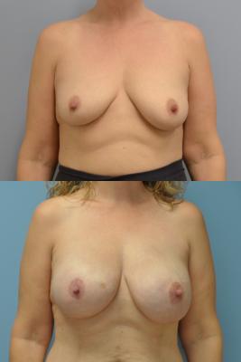 Before(top pic) After (bottom pic): Breast Reconstruction