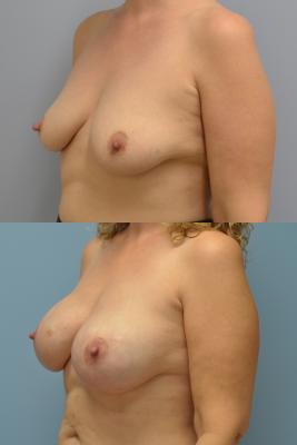 Before(top pic) After (bottom pic): Breast Reconstruction