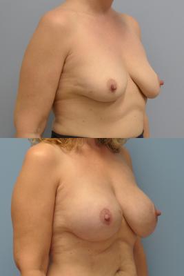 Before(top pic) After (bottom pic): Breast Reconstruction